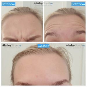 Anti wrinkle Injections in London Harley Street MD