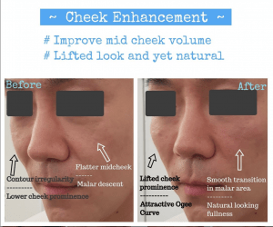 cheek enhancement