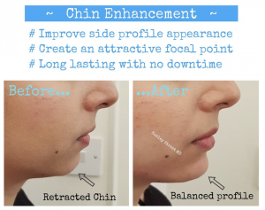 chin enhancement