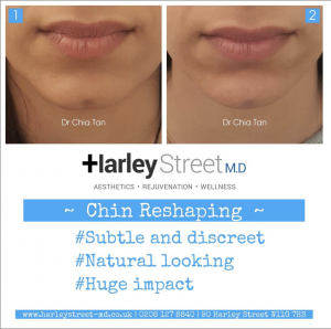 chin reshaping