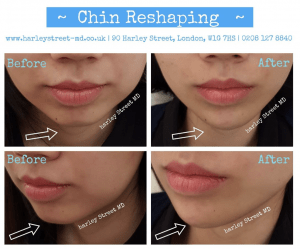 chin reshaping
