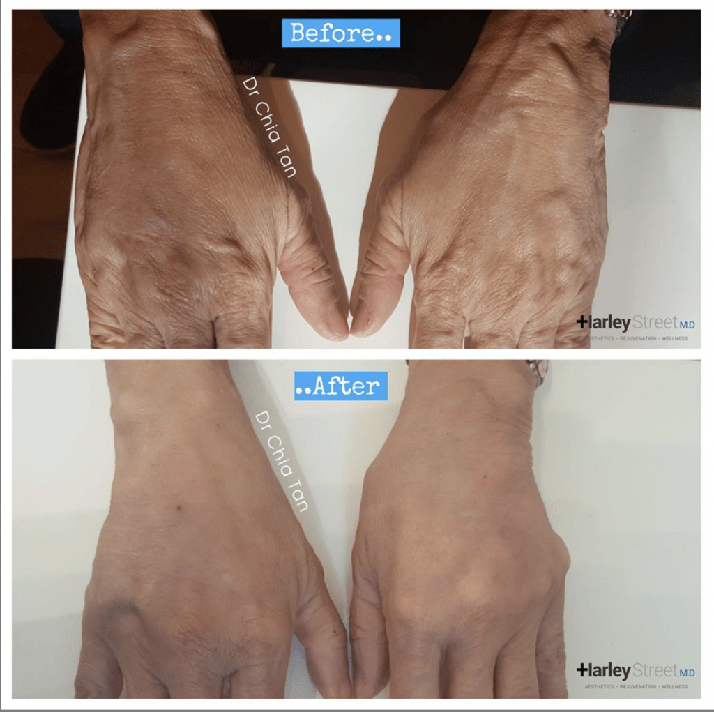 Hand Rejuvenation Treatment London Harley Street MD