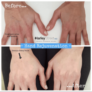 hand rejuvenation before and after