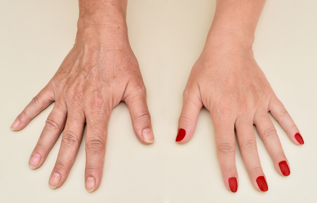 Hands of a woman before and after hand rejuvenation treatment