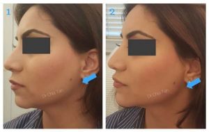 before and after image of jaw line reduction