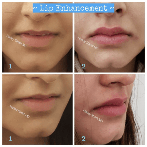 Best Dermal Fillers London, near Harley Street