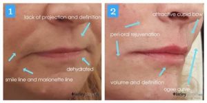 image showing lip enhancement treatment