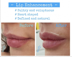 Before and after images for Harley Street lip fillers.