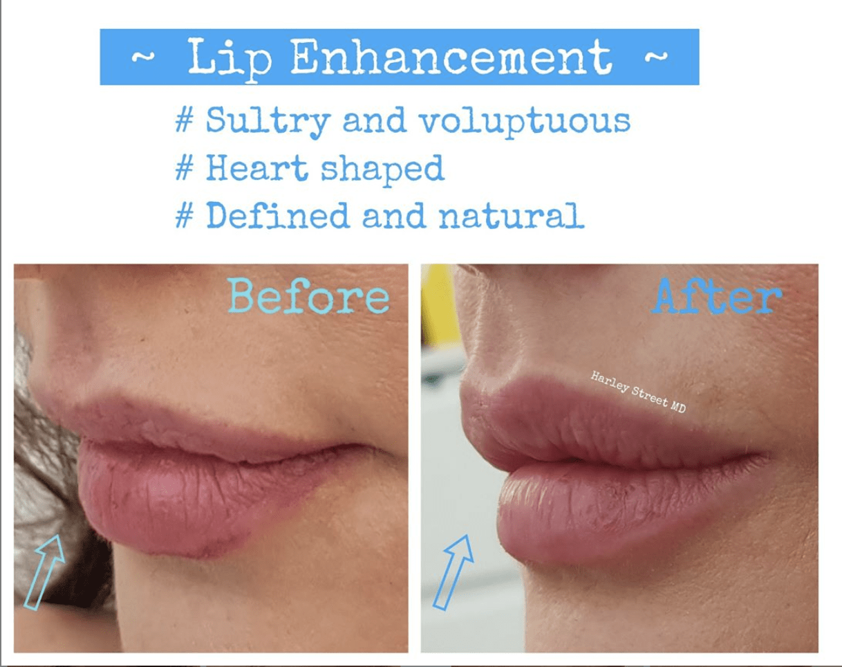 before and after images for lip enhancement