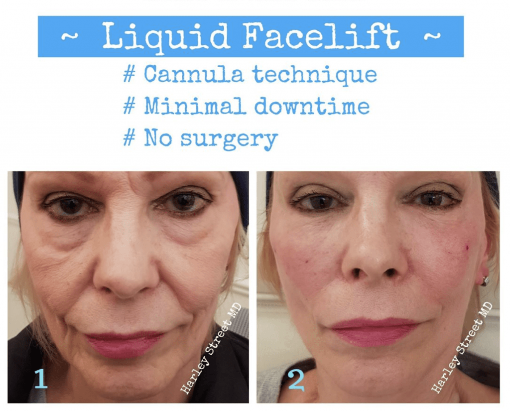 Liquid Facelift In London Non Surgical Harley Street Md