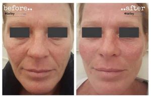 Before and after image of non surgical face lift in London.