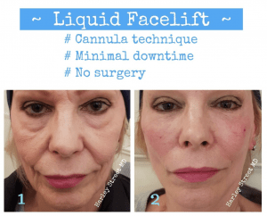 Liquid facelift before and after photos.