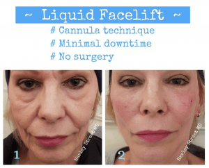 Liquid Facelift in London (Non-Surgical)