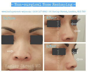 no surgical nose reshaping before and after