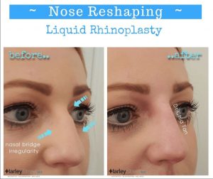 nose reshaping before and after photos
