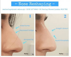 nose reshaping before and after photos