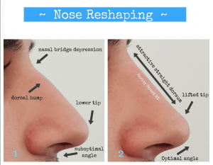 nose reshaping before and after photos