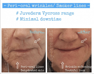 peri-oral lines before and after