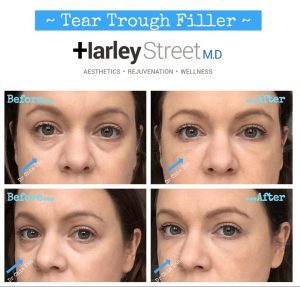 tear trough filler before and after.