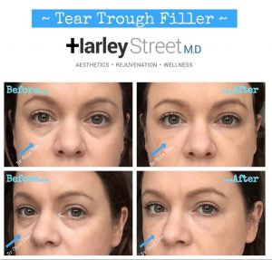 tear trough filler before and after