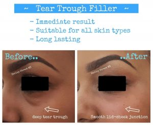 tear trough filler before and after.