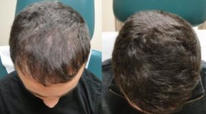 PRP hair loss treatment before and after photos.