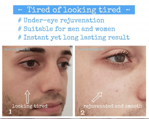 Under eye fillers for men - before and after photos.