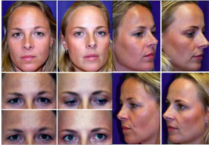 Botox before and after pictures.