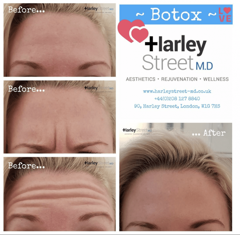 Botox in London | Harley Street MD