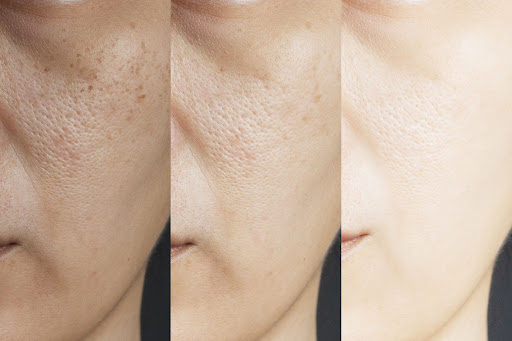 Skin before and after