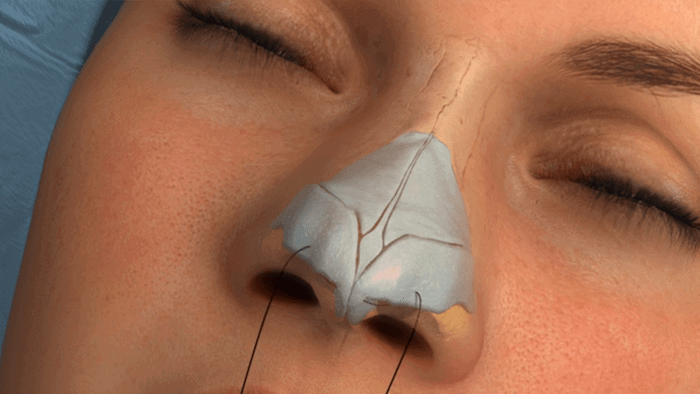 rhinoplasty