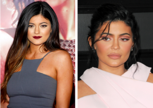 Kylie Jenner before and after cosmetic surgery