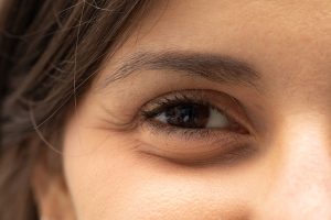 A closeup view on the eye of a pretty young woman. Details of a puffy eye bag are viewed, caused by fluid retention beneath the thin skin. Lady before blepharoplasty surgery.