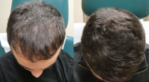 before and after prp for hair loss