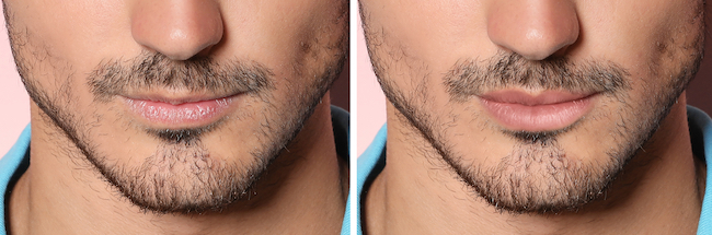 before and after male lip filler