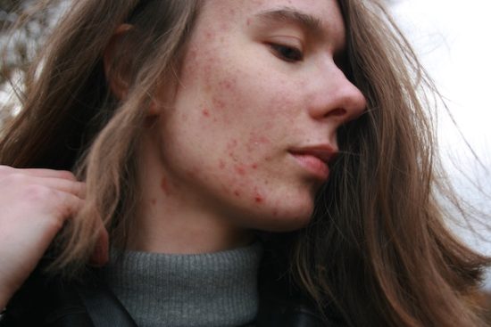 woman with cystic acne side profile