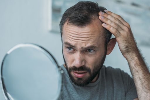 men hair loss and balding