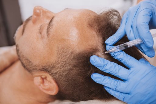 Close up of a mature man receiving hairloss treatment injections in scalp by professional trichologist.