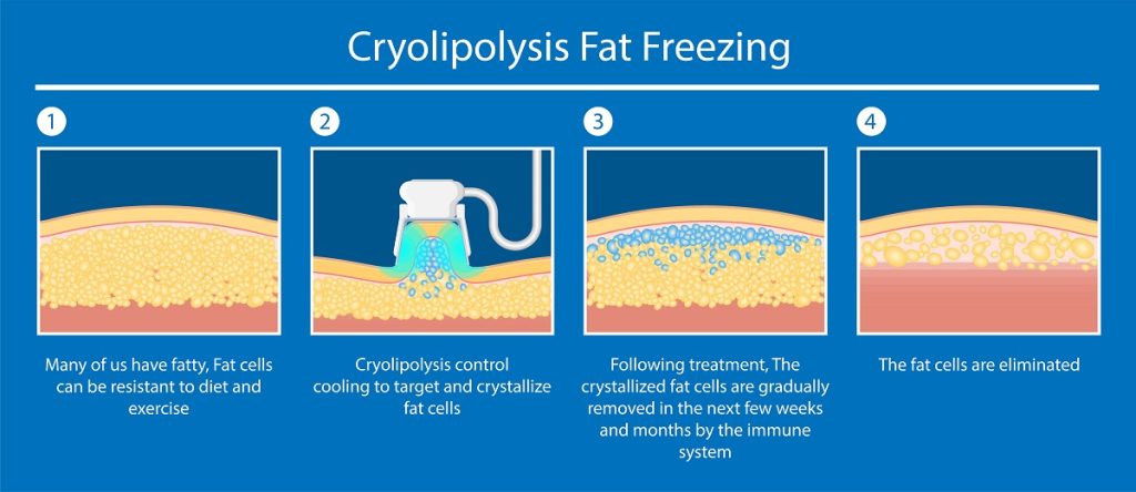 cryolipolysis fat freezing