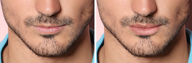 Male Lip Fillers: Before and After