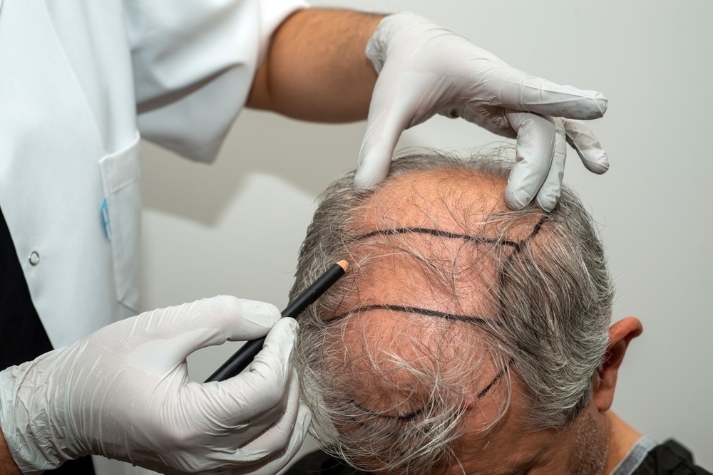 Marking hair line Point of receding hair line for hair transplant surgery