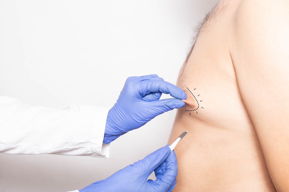 Gynecomastia Surgeries